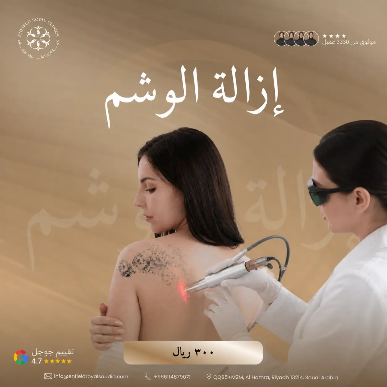إزالة الوشم