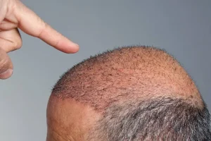 كم تكلفة زراعة الشعر (5000 بصيلة) في الرياض؟