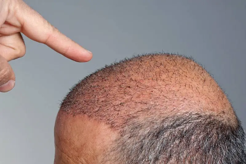كم تكلفة زراعة الشعر (5000 بصيلة) في الرياض؟