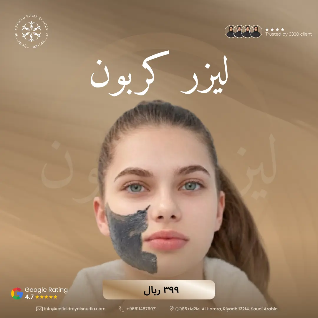 ليزر كاربون