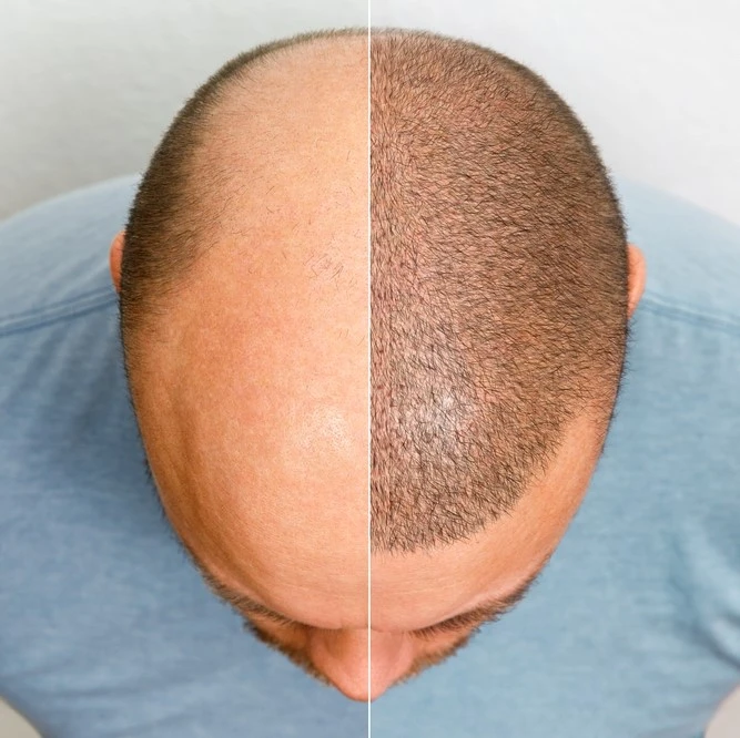 Alopecia Areata Treatment in Riyadh, Saudi Arabia 4 FUE hair transplant results