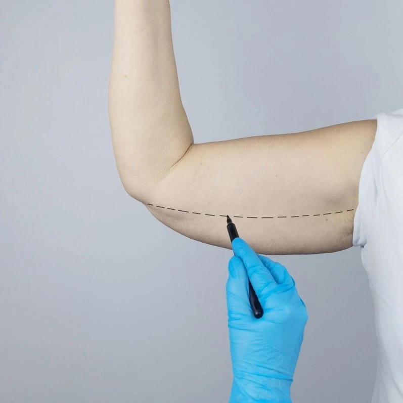 arm lift surgery procedure