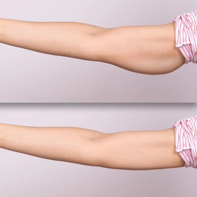 Arm Lift Surgery In Riyadh | Saudi Arabia 4 arm lift surgery results