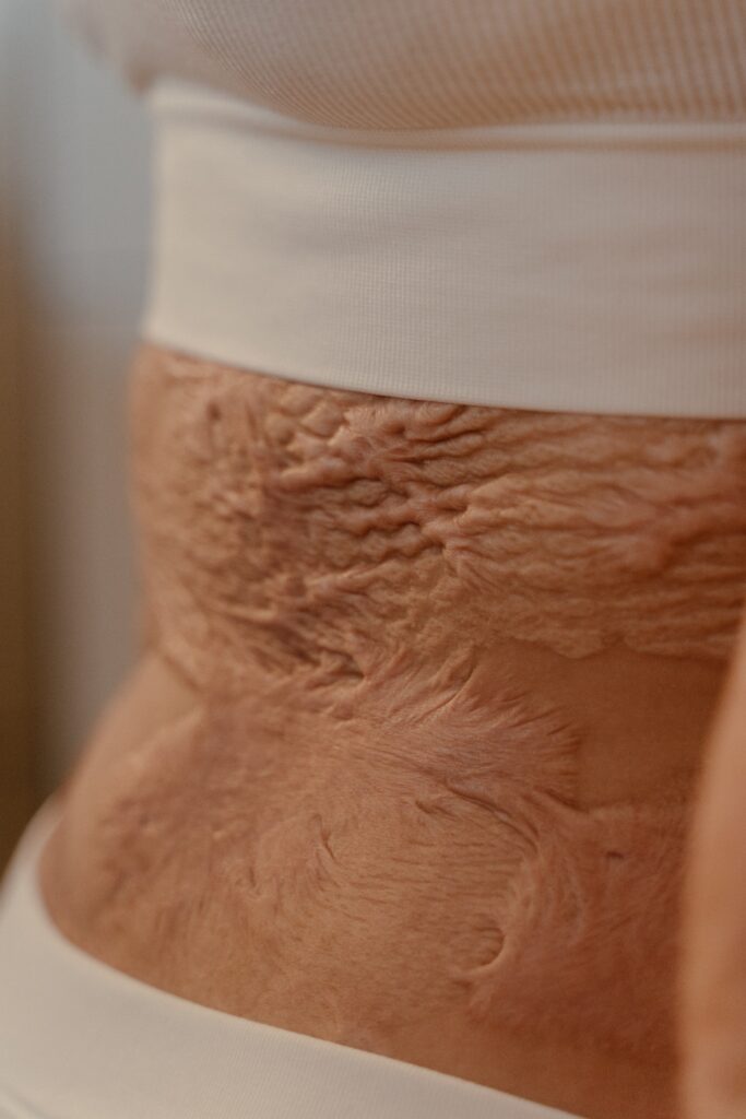 Burn Reconstructive Surgery in Riyadh