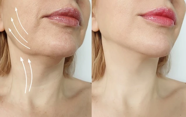 Stem Cell Facelift 3 facelift result