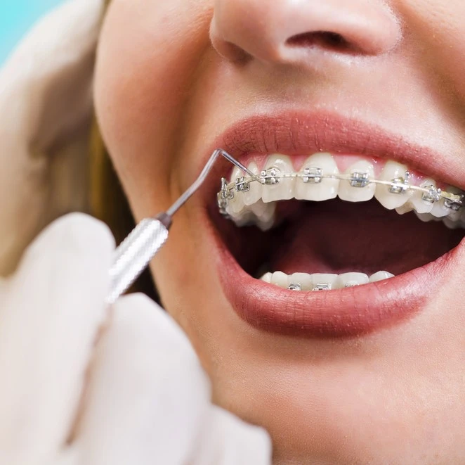 metal braces procedure