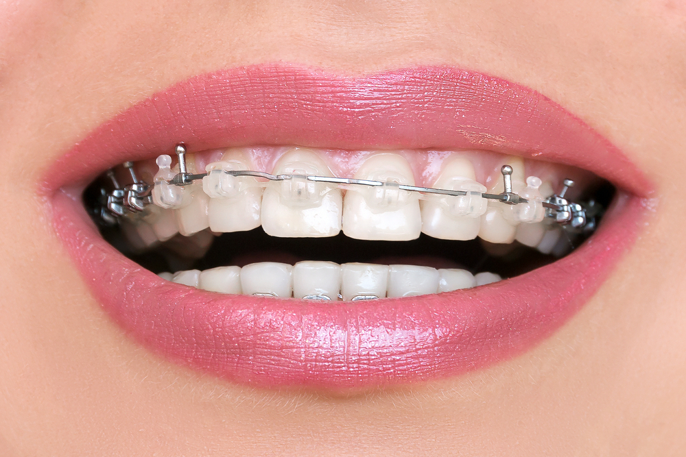 Damon Braces in Riyadh | Saudi Arabia 3 Damon Braces Results