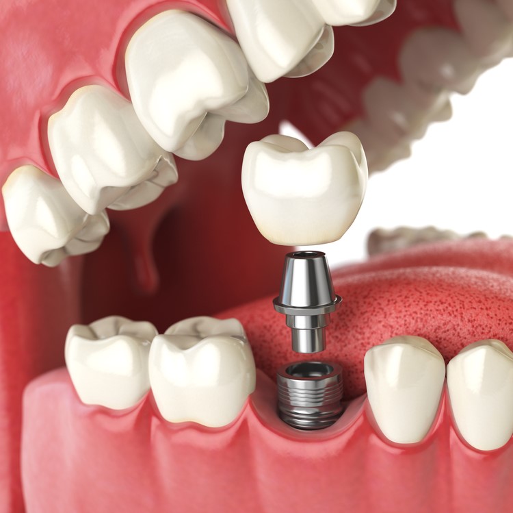 Dental Implants in Saudia Arabia