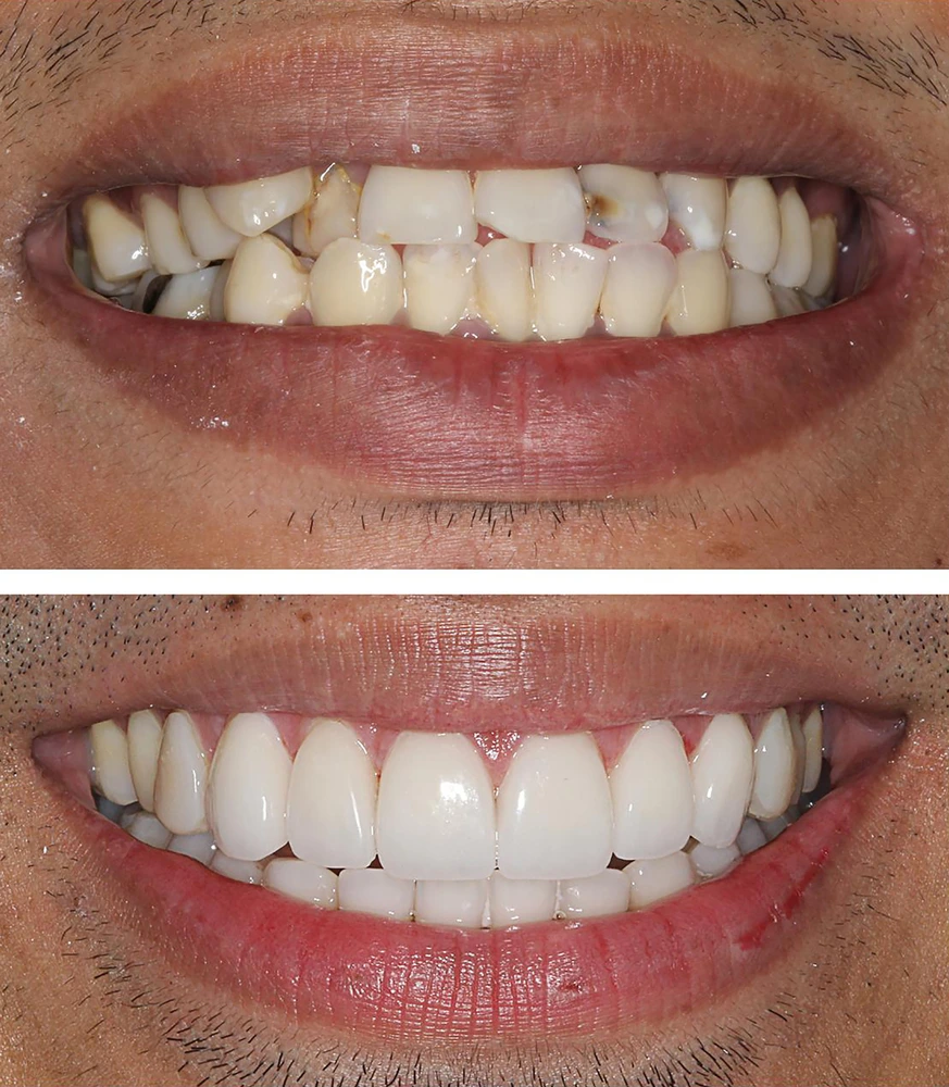 E Max Veneers before and after