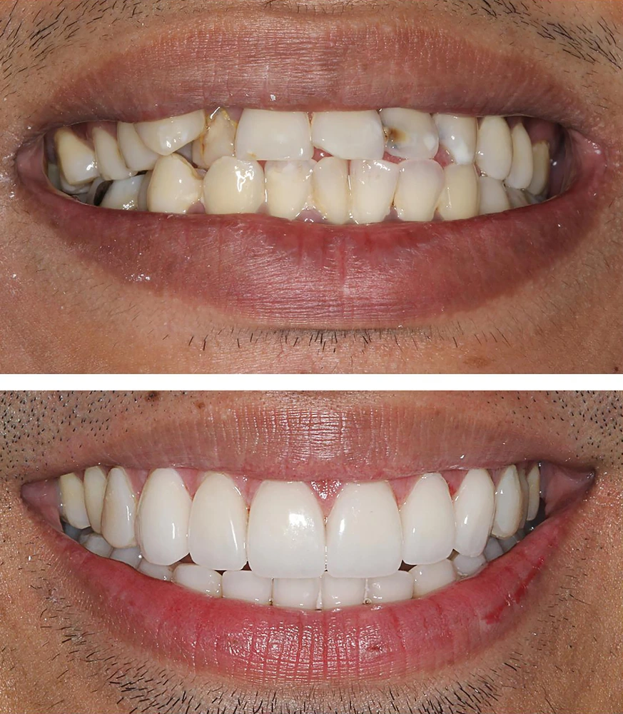 E-Max Veneers in Riyadh | Saudi Arabia 3 E Max Veneers before and after