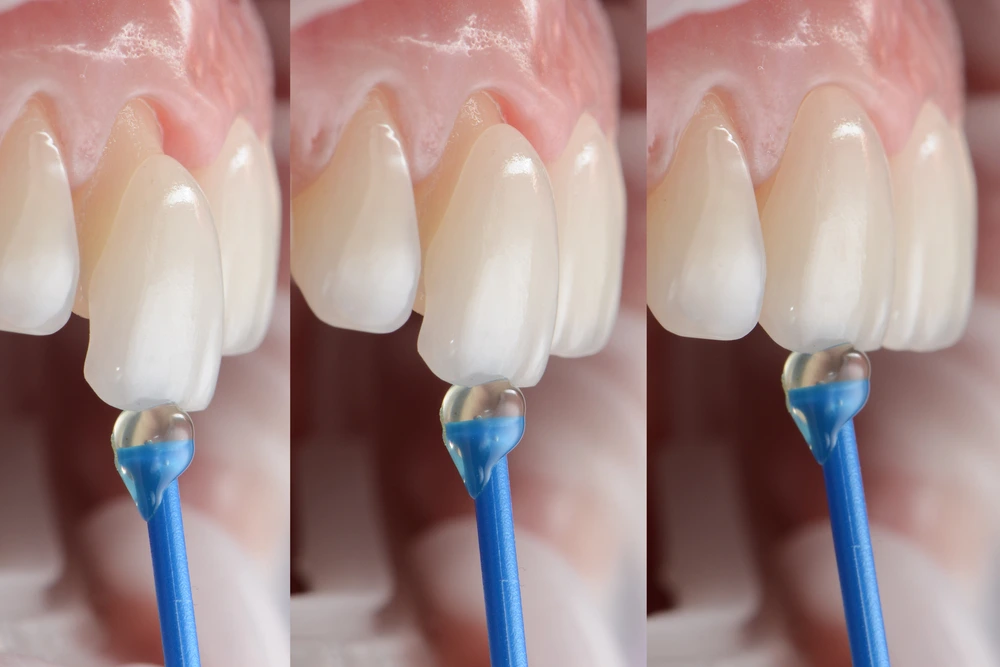 E Max Veneers procedure