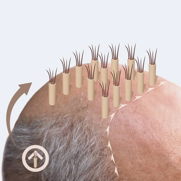 Hybrid Hair Transplant in Riyadh 1 FUE hair transplant work