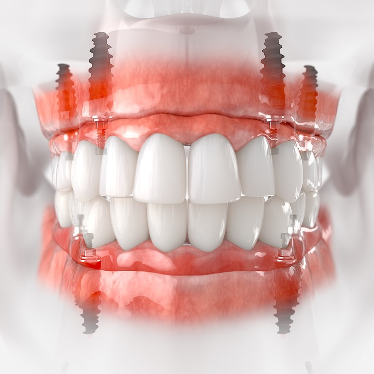 Zirconia Implants how does it works