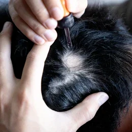 alopecia areata treatment procedure
