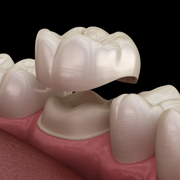 ceramic crowns how it works