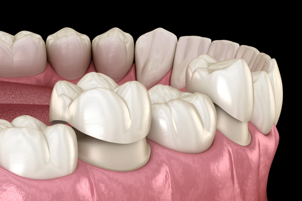 E-Max Crowns in Riyadh | Saudi Arabia 2 ceramic crowns procedure