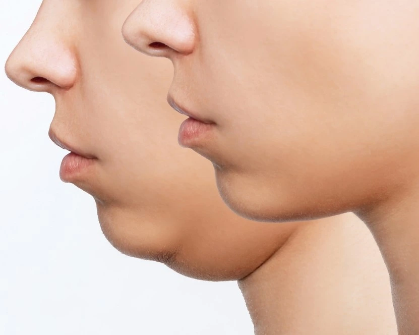 Belkyra Treatment in Riyadh | Saudi Arabia 3 chin reduction before and after