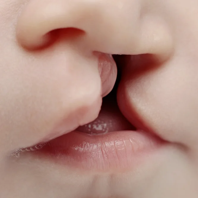 Palate Repair Surgery in Riyadh 1 Cleft Lip and Palate Surgery cost in Riyadh
