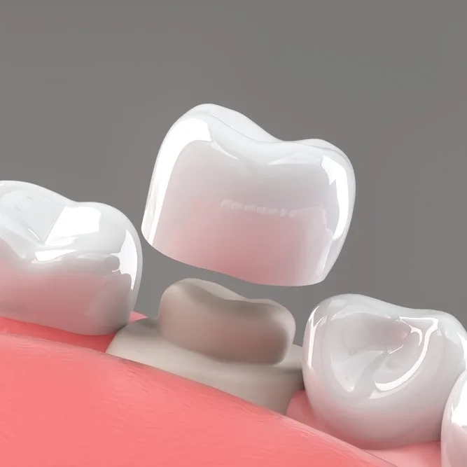 Gum Contouring in Riyadh 5 dental Crowns in saudia arabia
