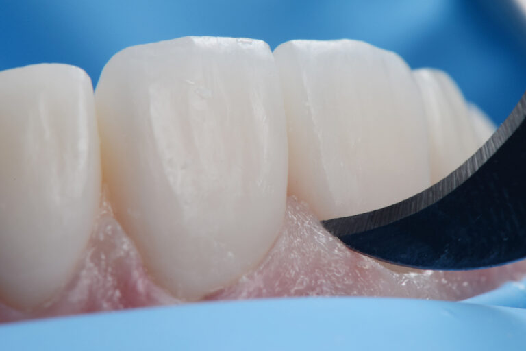 Dental Bonding Cement in Riyadh, Saudi Arabia Cost and Procedure
