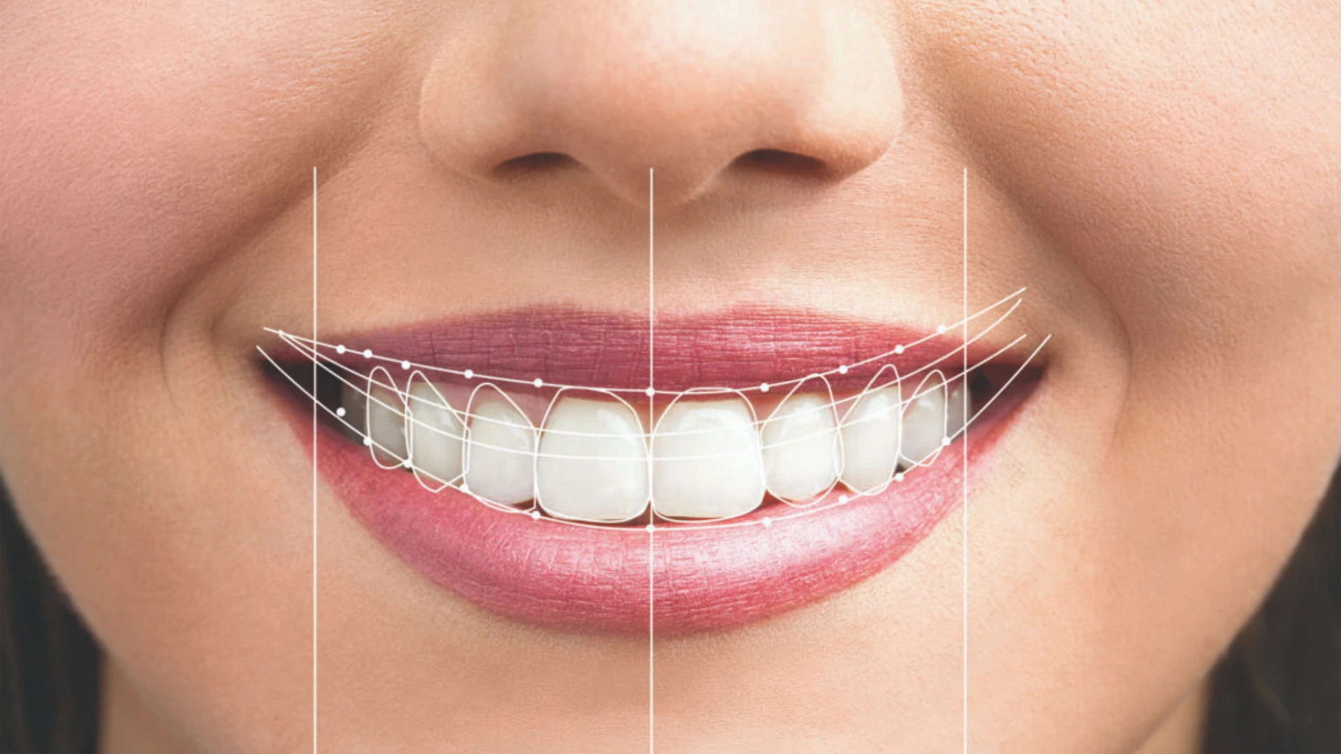Digital Smile Design in Riyadh | Saudi Arabia 1 digital smile design how it works