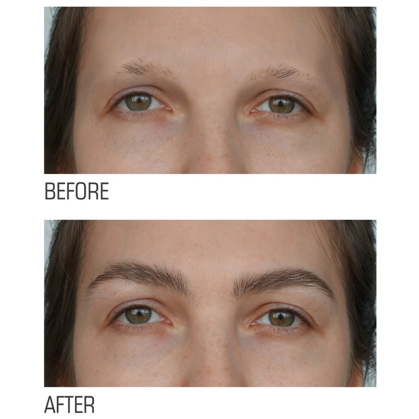 Eyebrows Hair Transplant in Riyadh | Saudi Arabia 3 eyebrow hair transplant before and after