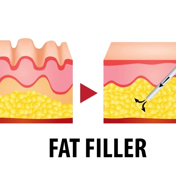 fat injections how they work