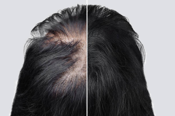 hair fillers for baldness before and after