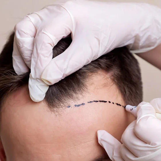 Stem Cell Hair Transplant in Riyadh 1 hair transplant how it works