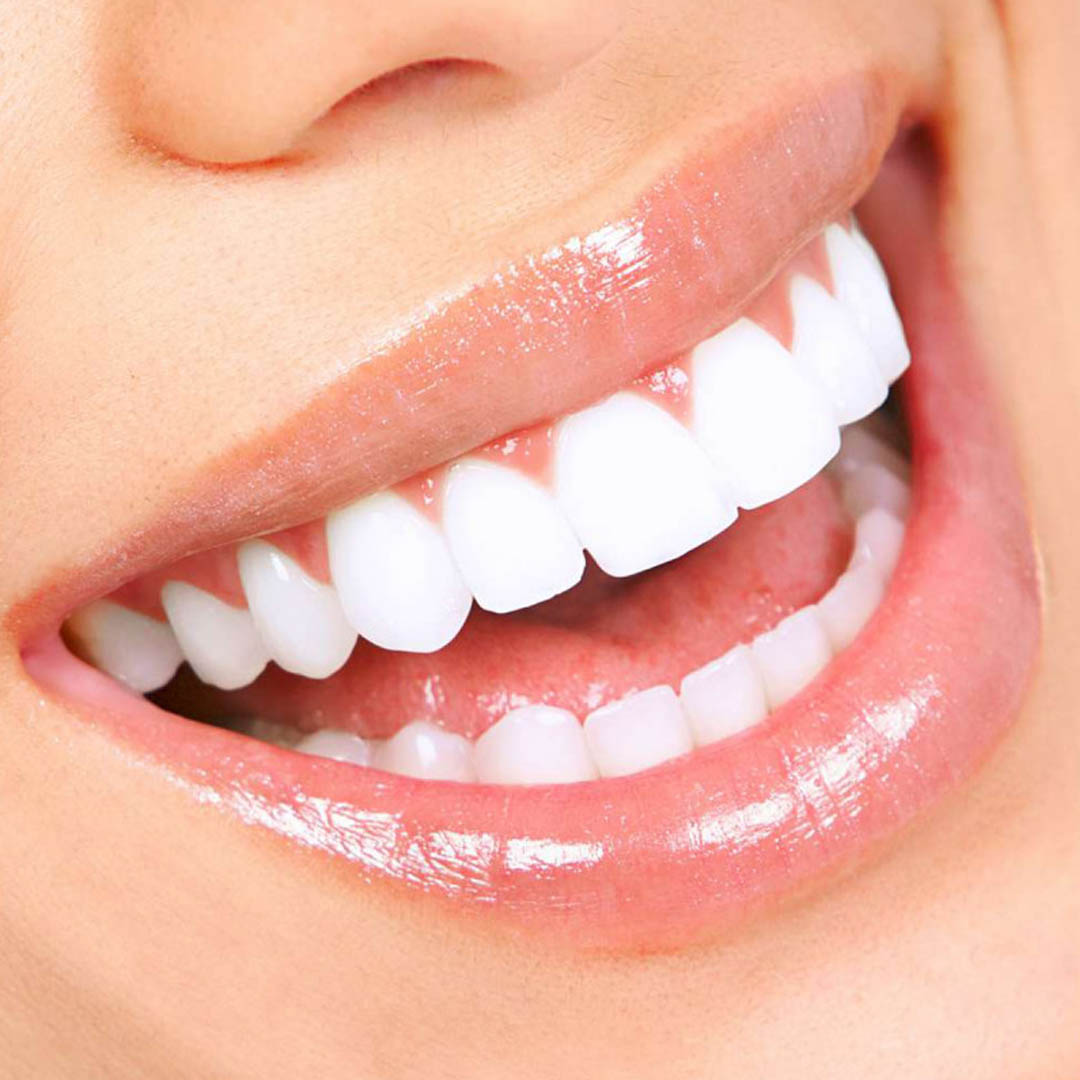 Gingivectomy in Riyadh 4 hollywood smile in saudi arabia