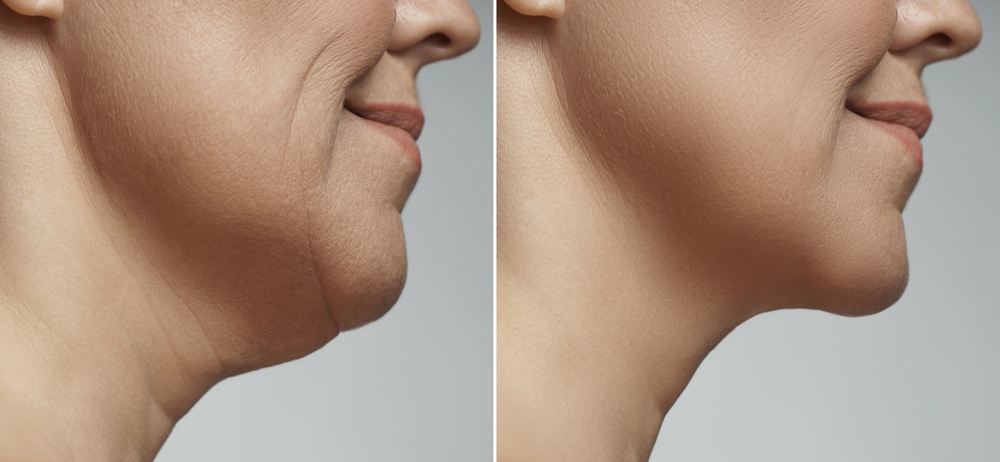 Jawline Contouring in Riyadh 3 jawline treatment Before After
