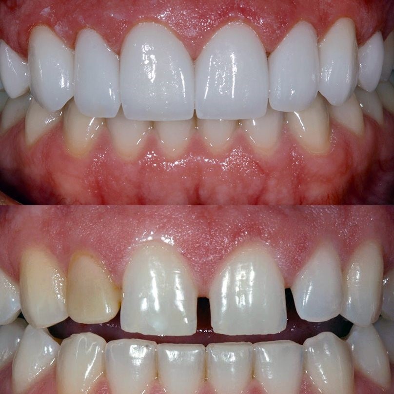 Non-Prep Veneers in Riyadh 3 non prep veneers before and after