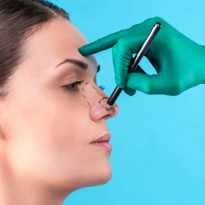 Alarplasty 1 rhinoplasty what is it