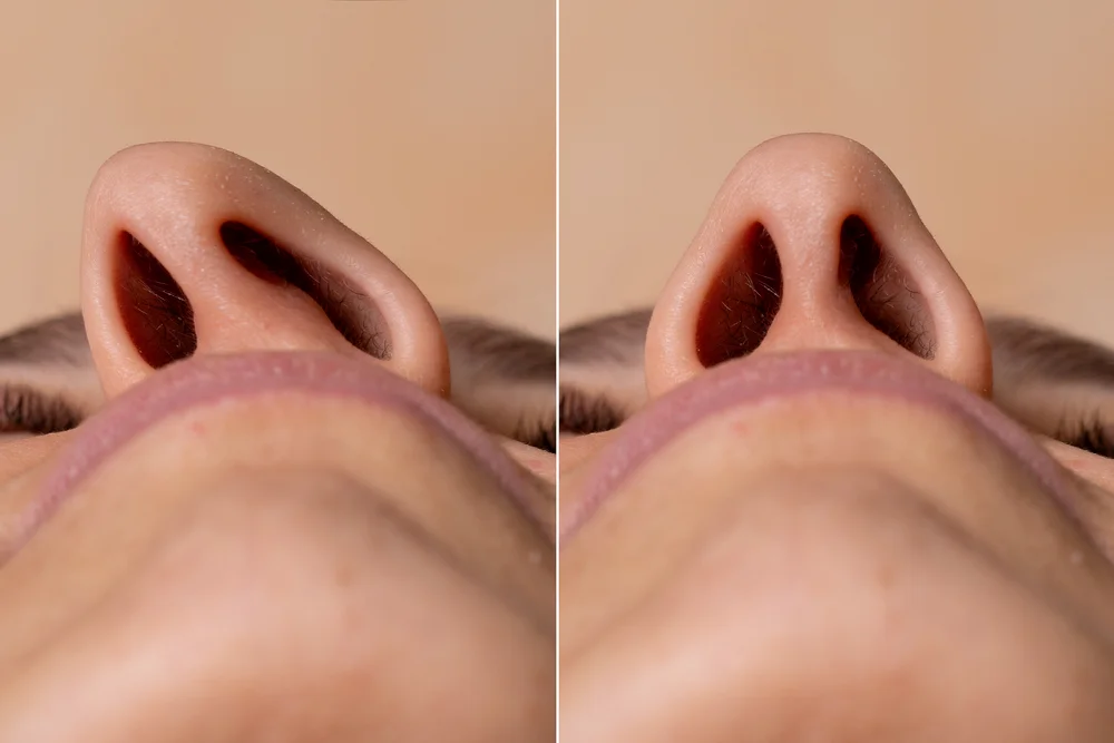 Septoplasty and Turbinate Reduction 3 septoplasty before and after 1