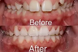 Dental Activators 3 Dental Activators before and after