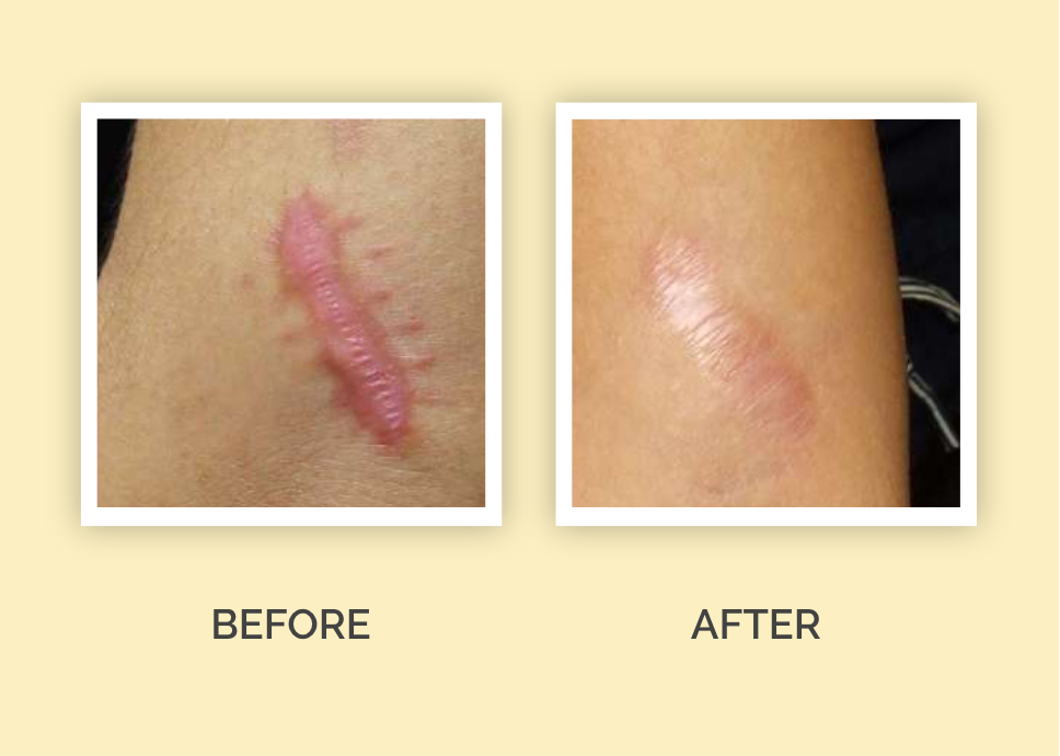 Hypertrophic Scars Treatment in Riyadh Enfield Royal Saudia