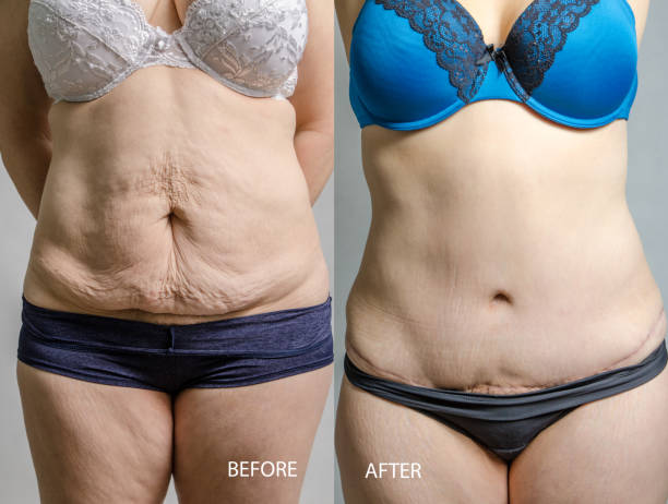 Get Your Dream Body with Lipo Abdominoplasty in Riyadh