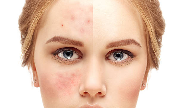 Subcision Treatment for Acne Scars in Riyadh 3 Subcision Treatment for Acne Scars before and after