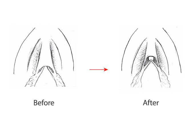 Clitoral Hoodectomy in Riyadh | Saudi Arabia 3 clitiros hood reduction before and after