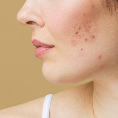 laser acne treatment in riyadh