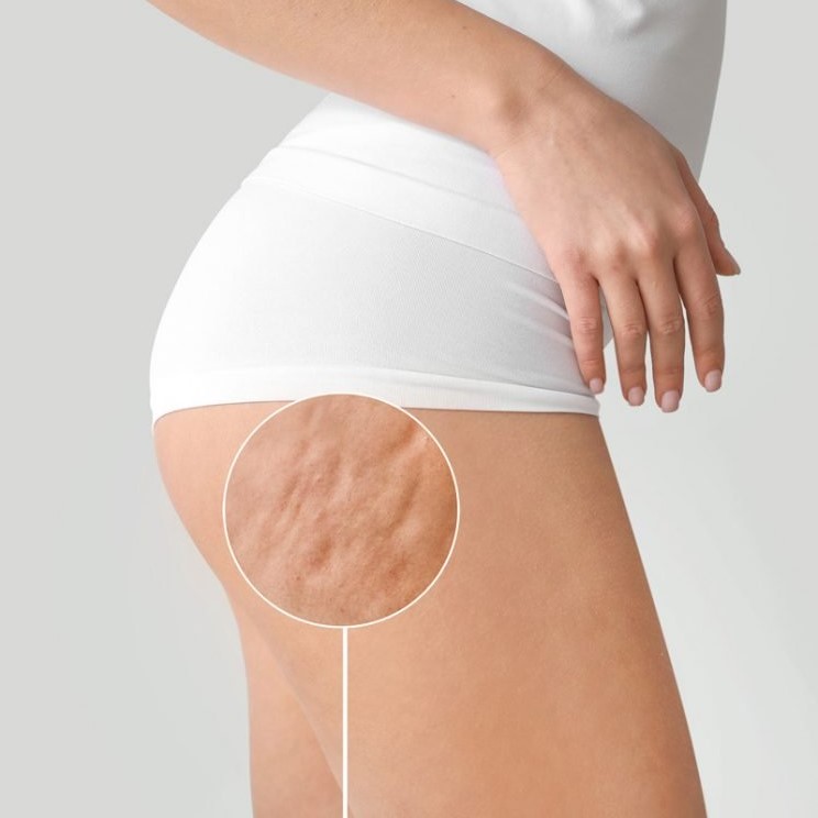 Cellfina Treatment in Riyadh | Saudi Arabia 4 Cellulite Removal Treatment in Riyadh
