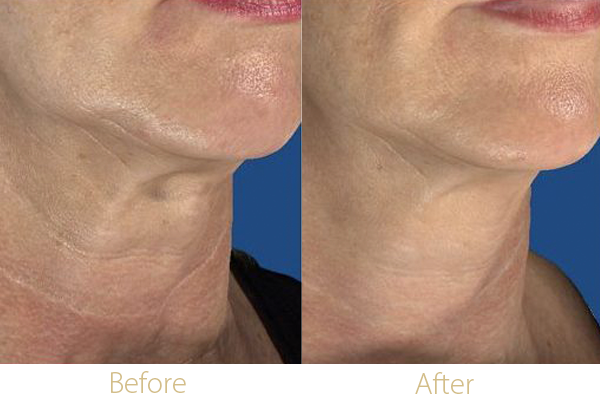 Fractional RF MicroNeedling 1 Fractional RF MicroNeedling before and after