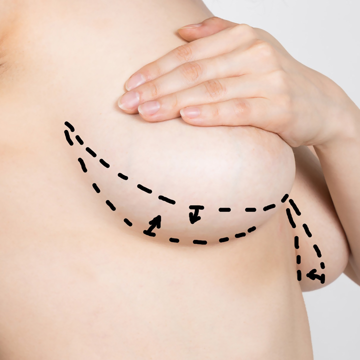 breast reduction how it works