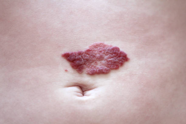 Hemangioma Treatment in Riyadh 1 hemangioma ideal candidate