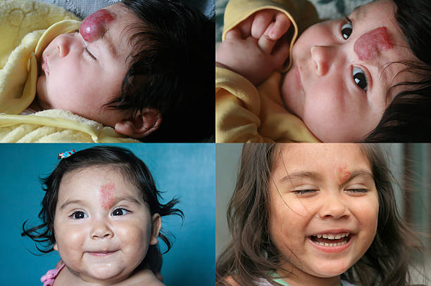 Hemangioma Treatment in Riyadh 3 hemangioma removal result