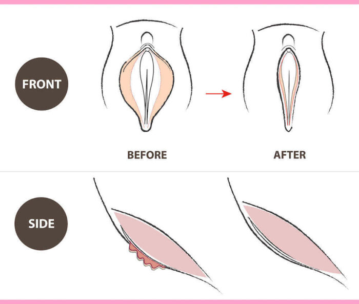labiaplasty before and after