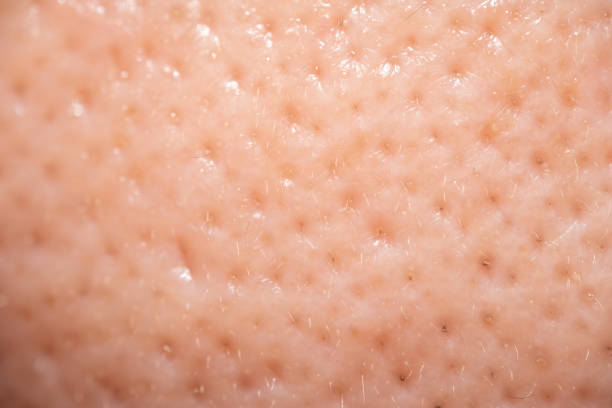 Large Pores Treatment in Riyadh 1 large pores treatment ideal candidate
