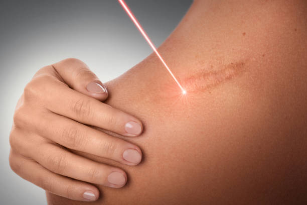 laser scar removal treatment in riyadh