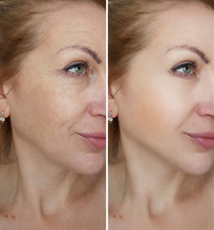 Laser Skin Resurfacing 1 laser skin resurfacing before and after