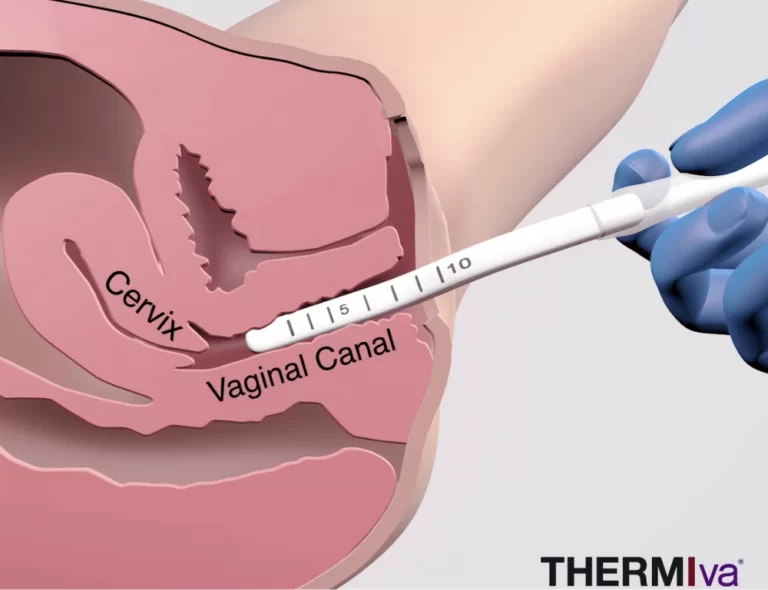 Thermiva Procedure 1 thermiva procedure how it works